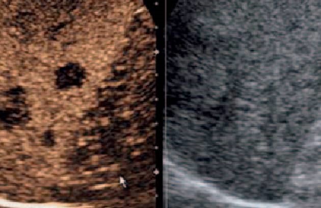 Contrast Enhanced Ultrasound (2) Min