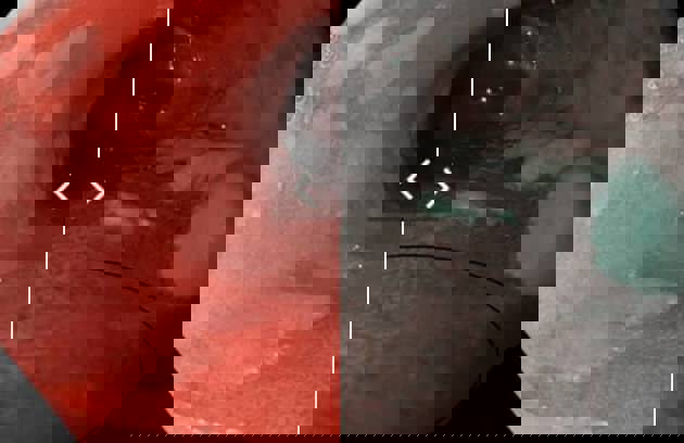 Narrow Band Imaging